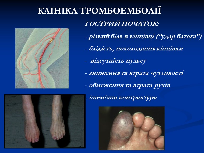 КЛІНІКА ТРОМБОЕМБОЛІЇ ГОСТРИЙ ПОЧАТОК: різкий біль в кінцівці (“удар батога”) блідість, КЛІНІКА ТРОМБОЕМБОЛІЇ ГОСТРИЙ ПОЧАТОК: різкий біль в кінцівці (“удар батога”) блідість,